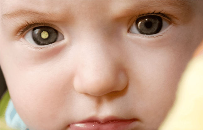 cataract-can-be-caused-by-eye-injuries-in-children