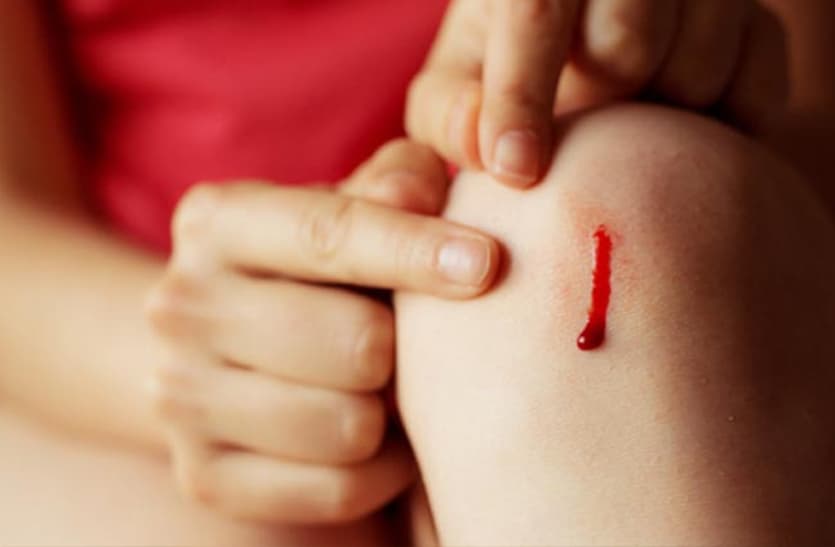 stop-bleeding-immediately-know-these-home-remedies