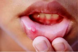 Danger sign of mouth ulcers: 14 दिन से ज्यादा मुंह में बने रहें छाले, तो तुंरत कराएं जांच, जाने माउथ अल्सर के गंभीर कारण