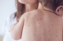 Measles vaccine : ऑपरेशन से पैदा हुए बच्चों में खसरे का टीका कम प्रभावी!