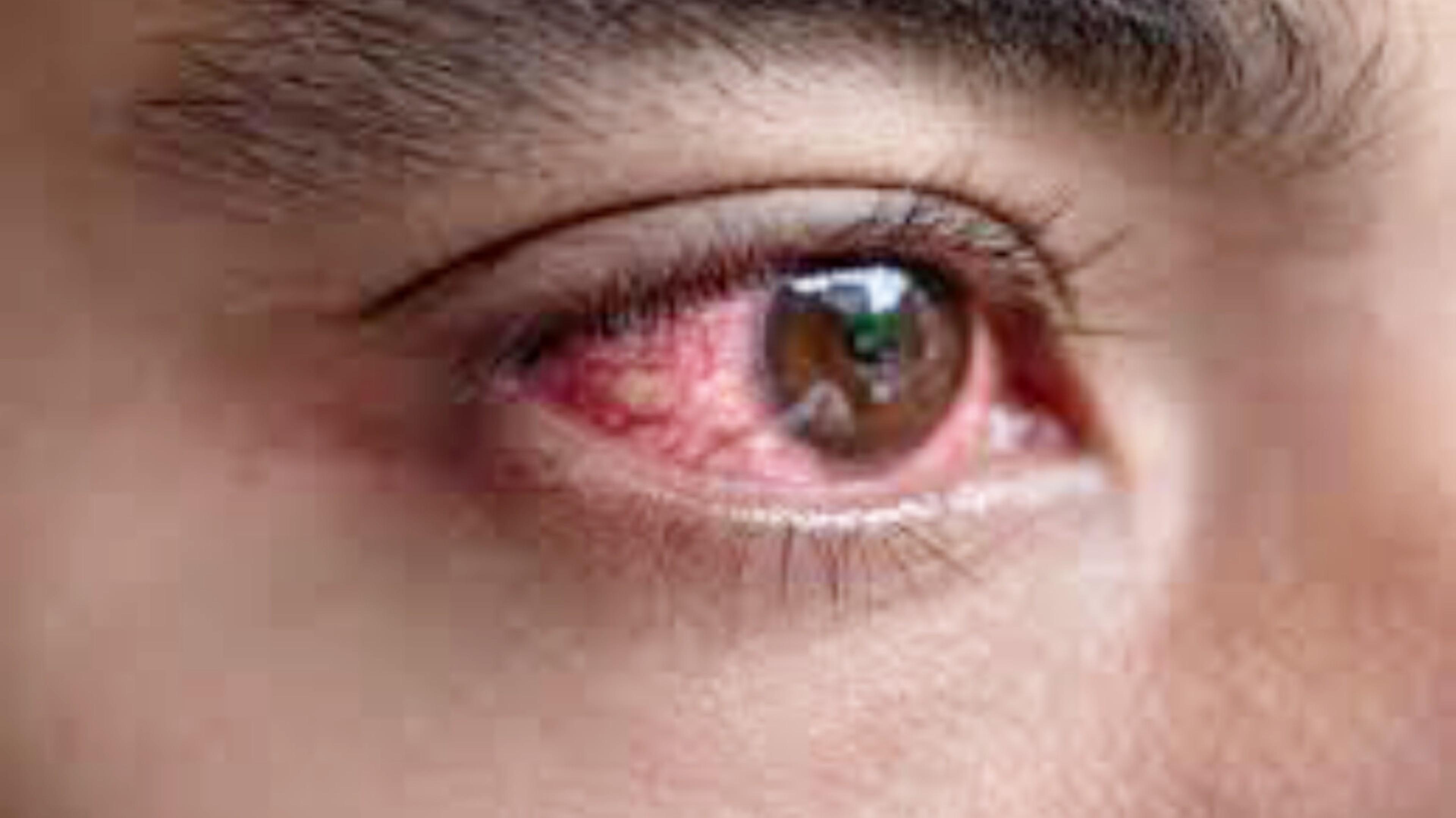 Kanpur Eye Flu: तेजी से पांव पसार रहा ‘आई फ्लू’, इन्फेक्शन से बचने के लिए “क्या
करें और क्या ना करें”