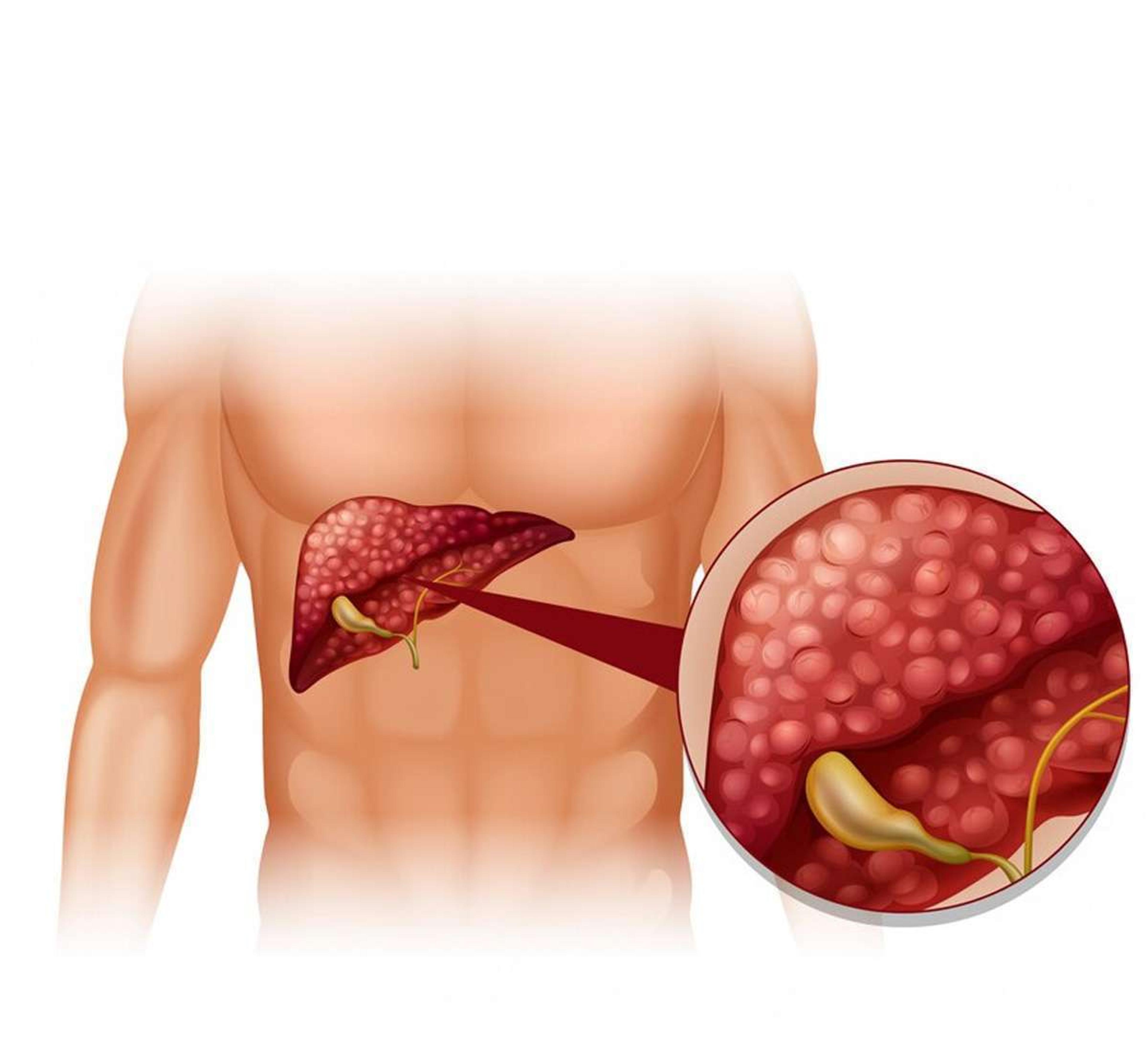 Liver Cancer Symptoms : फ्लू जैसे लक्षण? सावधान हो जाएं, लिवर कैंसर का हो सकता है खतरा