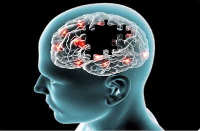 अल्जाइमर के बारे में जानें, क्या हैं लक्षण और कारण