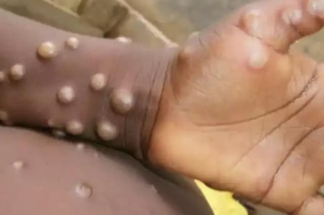 High Risk of Monkeypox:  जानिए किसे मंकीपॉक्स होने का सबसे ज्यादा खतरा है? हाई इम्युनिटी वाले भी सेफ नहीं होंगे