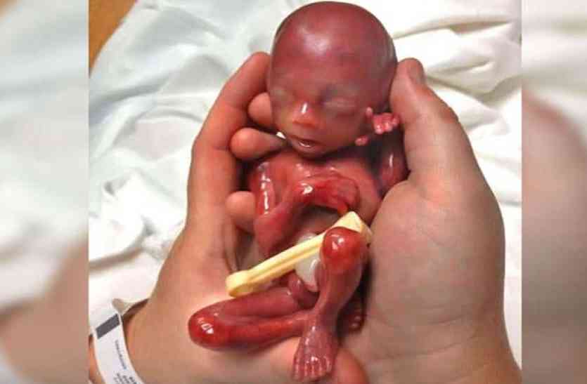 premature baby महिला ने दिया पांचवें महीने में बच्चे को जन्म, यहां देखें तस्वीरें