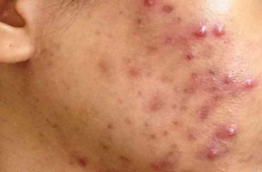 Acne मुंहासों को यूं रखें दूर