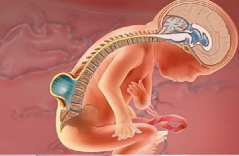 spina-bifida-affects-the-mental-development-of-the-infant स्पाइना बाइफिडा से पड़ता शिशु के मानसिक विकास पर बुरा असर