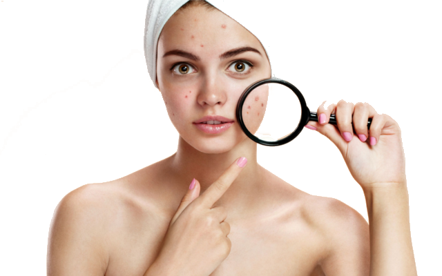 acne,remove acne scars,get rid of acne,