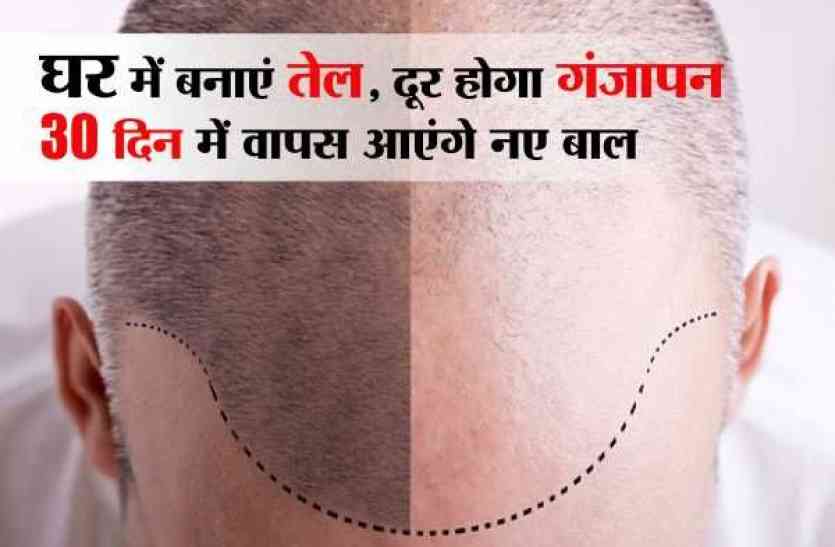 easy and efficient home remedies for get rid of hair fall, Home tips, hair fall, mp utility, easy and efficient home remedies, rid of hair fall, 5 good thing, reduce hair loss, new hair will come, home remedies, home tips for hair fall, tips, #gharelu #tips easy and efficient home remedies -ये घरेलु उपाए दूर कर देगा गंजापन, अपनाएं ये तरीका