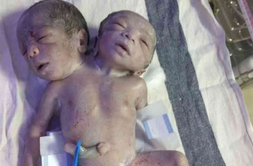 Khandwa has two children born in the mouth Amazing: दो मुंहे बच्चे ने लिया जन्म, सिर दो शरीर एक