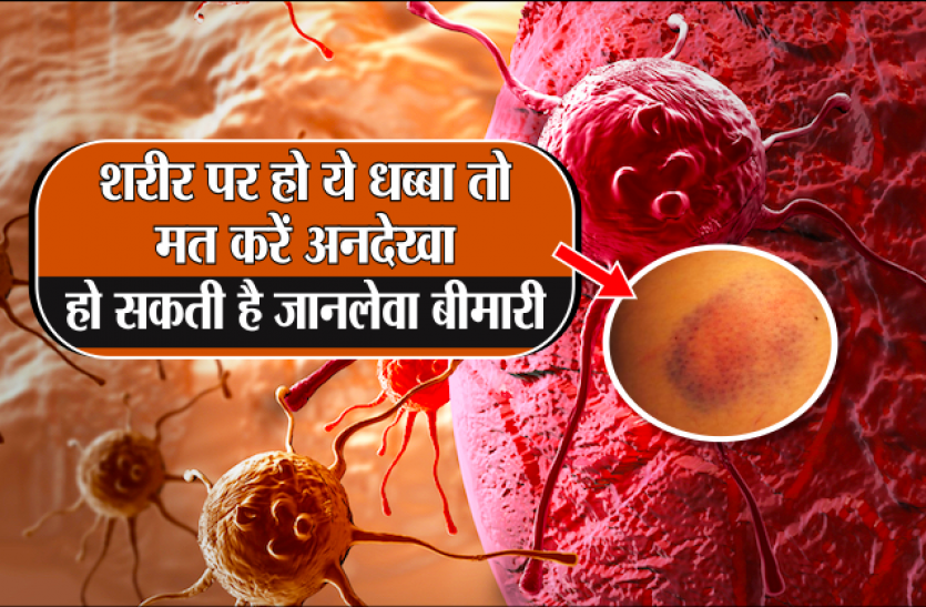 what-is-blood-cancer-signs-and-symptoms-latest-news-in-hindi