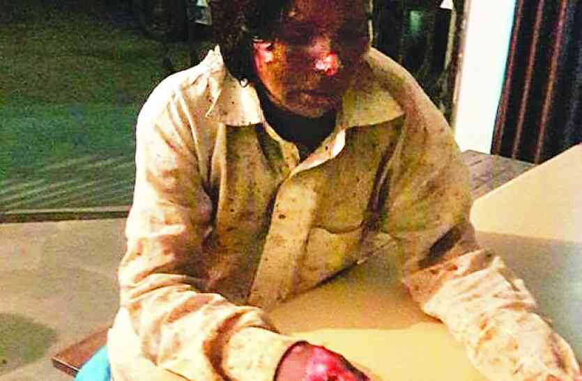 dewas burnt case मायके जाने की बात पर पति ने किया पत्नी का ये हश्र
