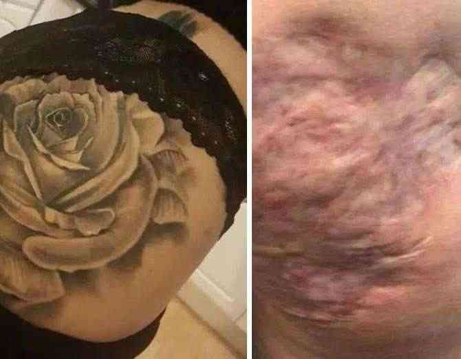Woman Unable To Sit For 10 Years