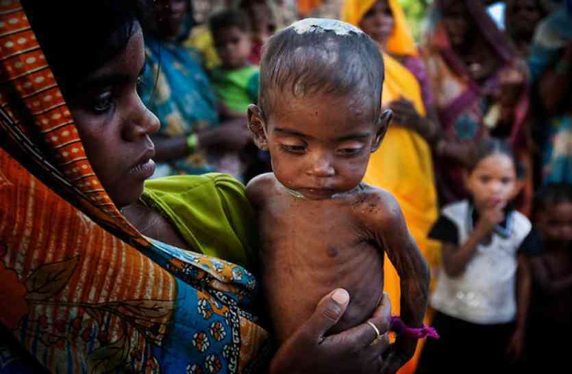 More malnourished children found in urban areas शहर के सैकड़ों बच्चों में पल रही थी ये गंभीर बीमारी, ऐसे हुआ खुलासा