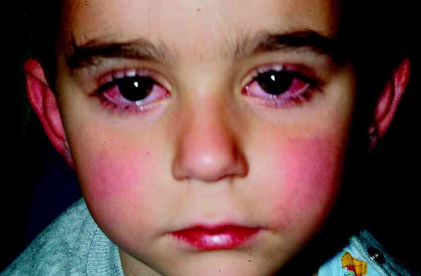 disease kawasaki came from japan in rajasthan patient found in ajmer जापान से राजस्थान पहुंची एक अजीब बिमारी, ध्यान दें कहीं आपके बच्चे के दिल पे भी ना कर दे वार