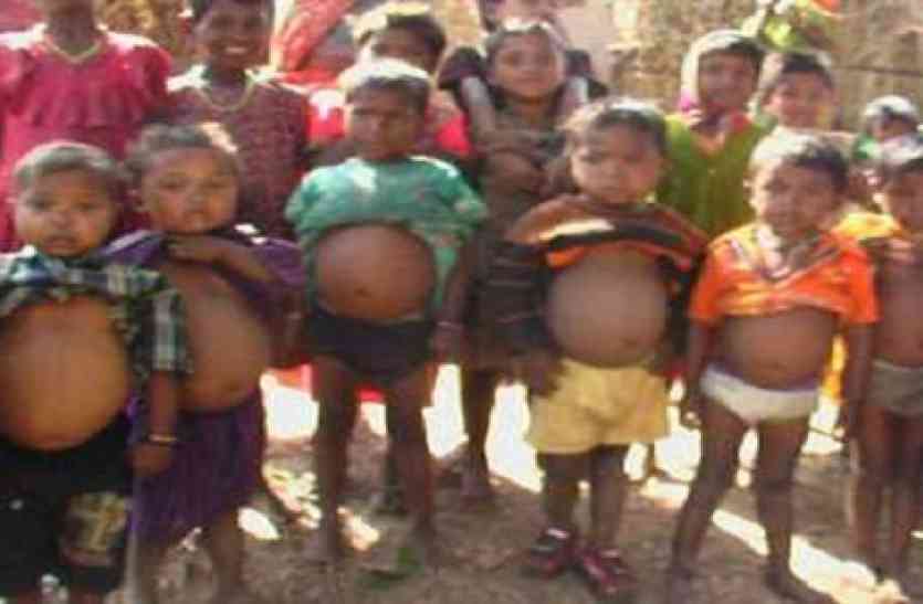 Malnourished children Special Report: कुपोषण से निपटने में अफसर फेल, बढ़ रही कुपोषित बच्चों की संख्या