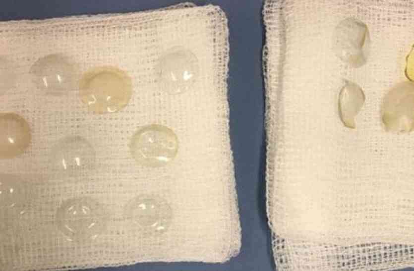 Lenses आंखों का चेकअप कराने गई थी 67 साल की महिला, ये राज़ जानकर डॉक्टरों की खो गई याद्दाश्त