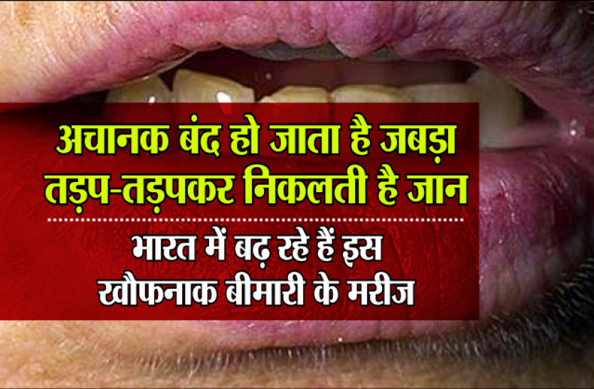 oral cancer डॉक्टर टिप्स: आसान है ओरल कैंसर का पता लगाना, इस तरह करें खुद की जांच, धुम्रपान से होता है ये अधिक