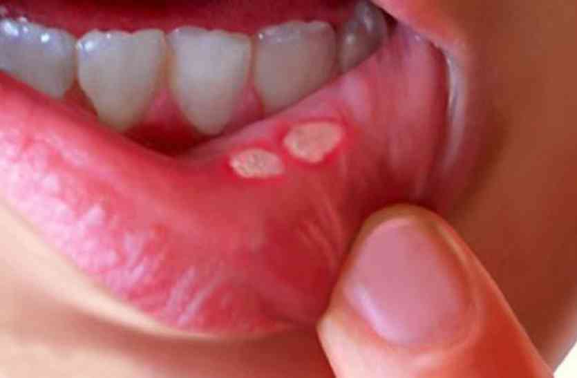 Mouth Ulcer Is A Symptoms Of Cancer Be Alert - मुंह के छाले ठीक करने के लिए  गोलगप्पे खाने से हो सकता है ऐसा हाल | Patrika News