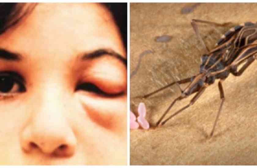 disease,hiv aids,AIDS,pulse polio,Stone,polio,chronic neurological disease,xeroderma pigmentosum,syndrome,neurological disease,
