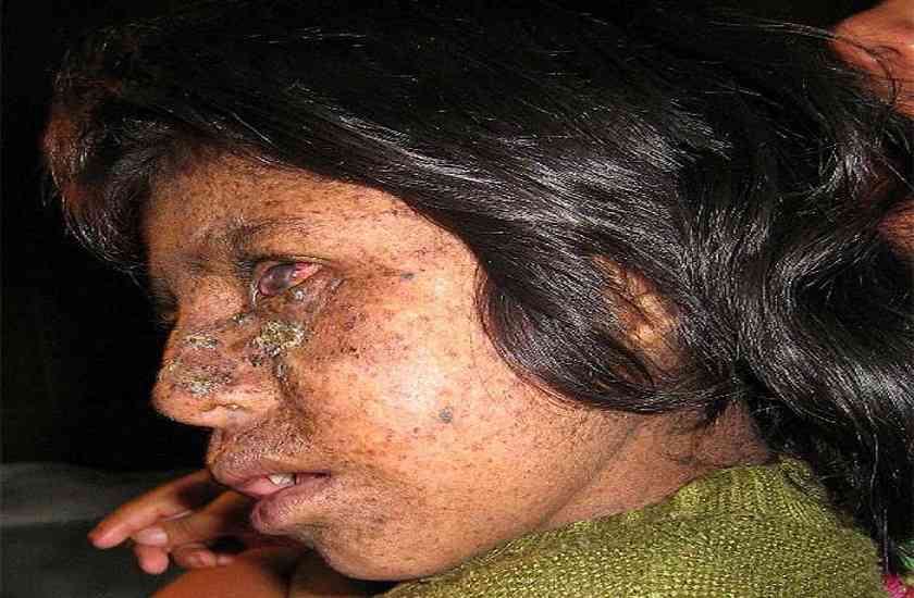 disease,hiv aids,AIDS,pulse polio,Stone,polio,chronic neurological disease,xeroderma pigmentosum,syndrome,neurological disease,