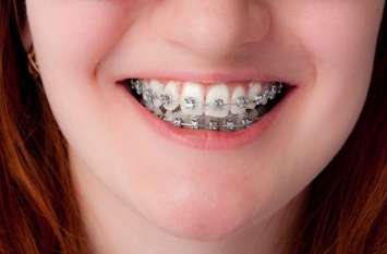 Braces Braces