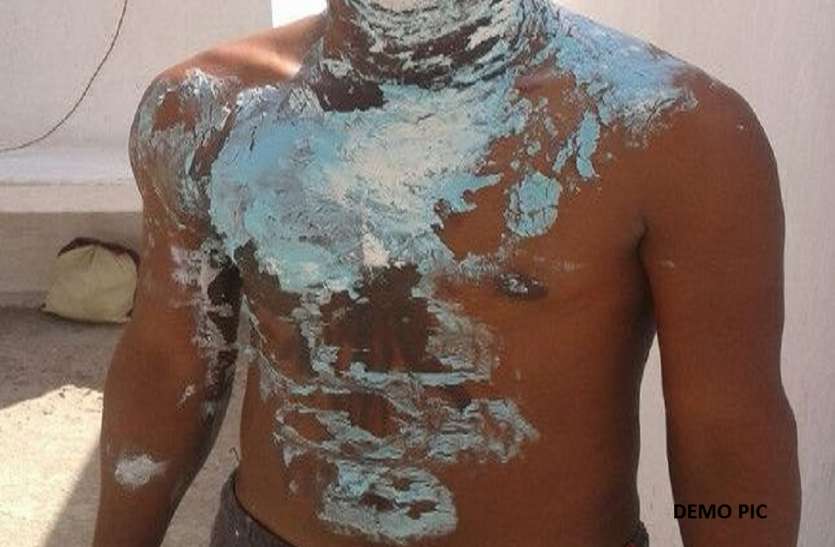 crime case गुस्सैल बेटे ने पिता पर फेंका खौलता हुआ तेल, झुलसा