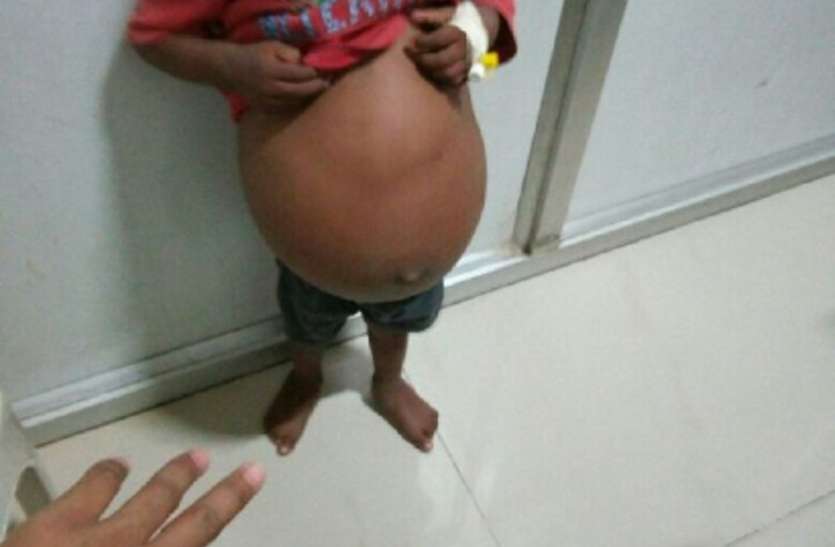 War with malnutrition at the age of play in rewa खेलने-कूदने की उम्र में कुपोषण से जंग