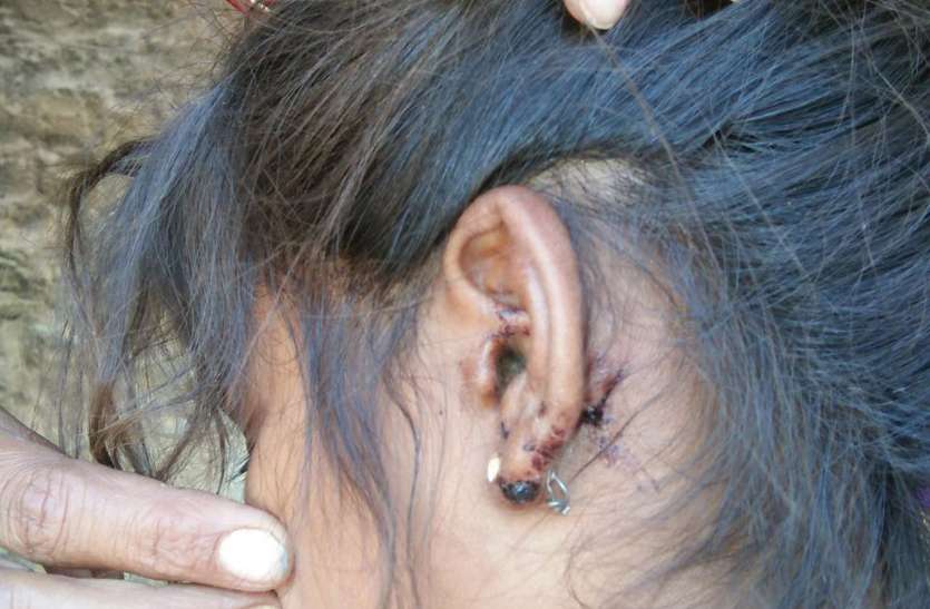 dog bite यहां श्वानों का कहर, घरों से बाहर निकलने से घबरा रहे लोग
