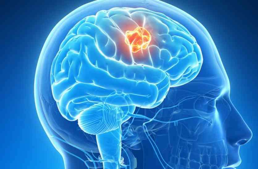 Brain Tumor World Brain Tumor Day : ब्रेन ट्यूमर दिवस पर खास रिपोर्ट , ट्यूमर से जुड़ी मुख्य बातें और उनका सच