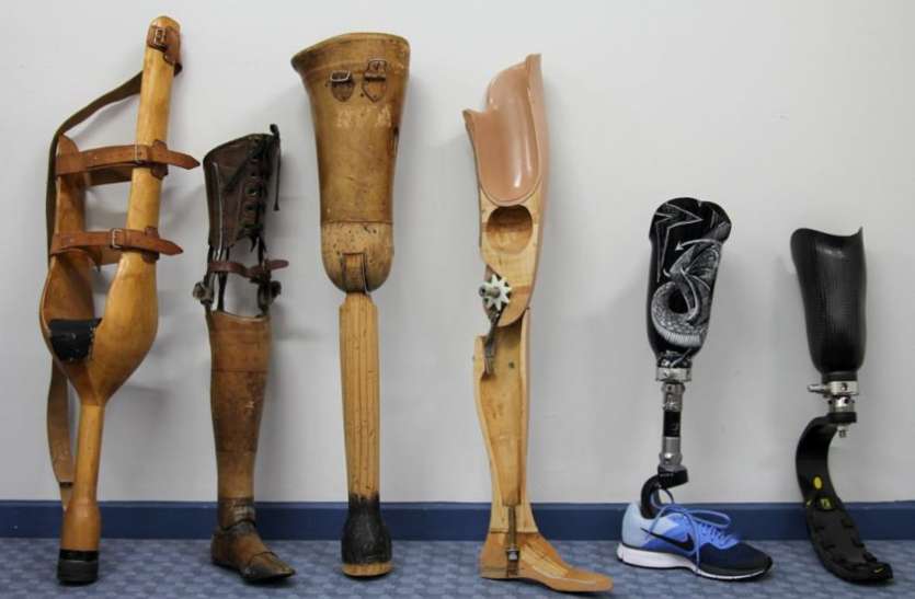 artificial leg कृत्रिम पैर से जीवन में नया कदम