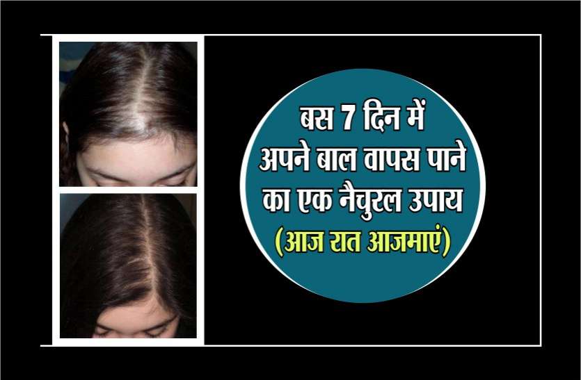 बस 7 दिन में अपने बाल वापस लाने का नेचुरल उपाय, आज रात अपनाएं बस 7 दिन में अपने बाल वापस पाने का एक नेचुरल उपाय, आज रात आजमाएं