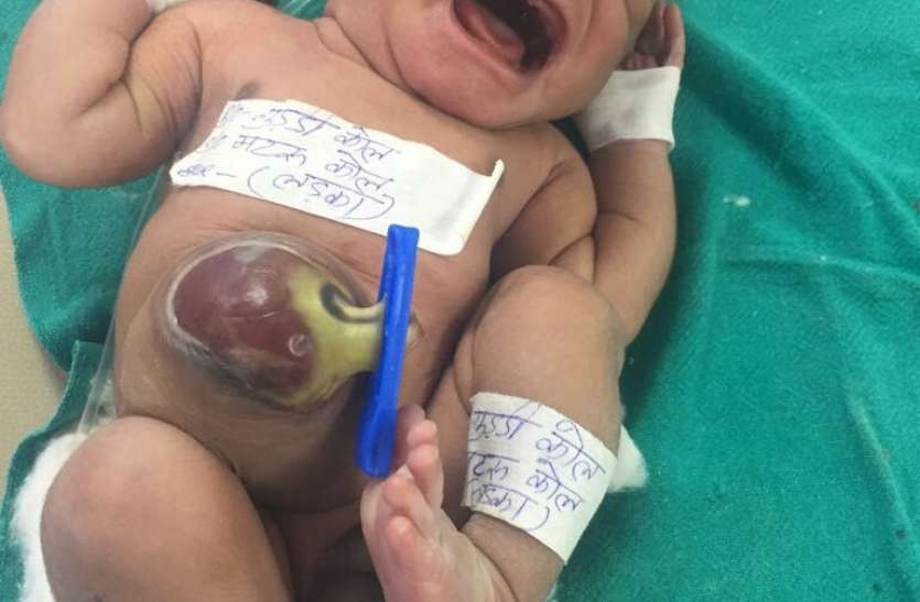 Not made stomach wall, gutted intestine कुपोषण से भयावह हो रहे हालात, नहीं बनी पेट की दीवार, बाहर निकली आंत