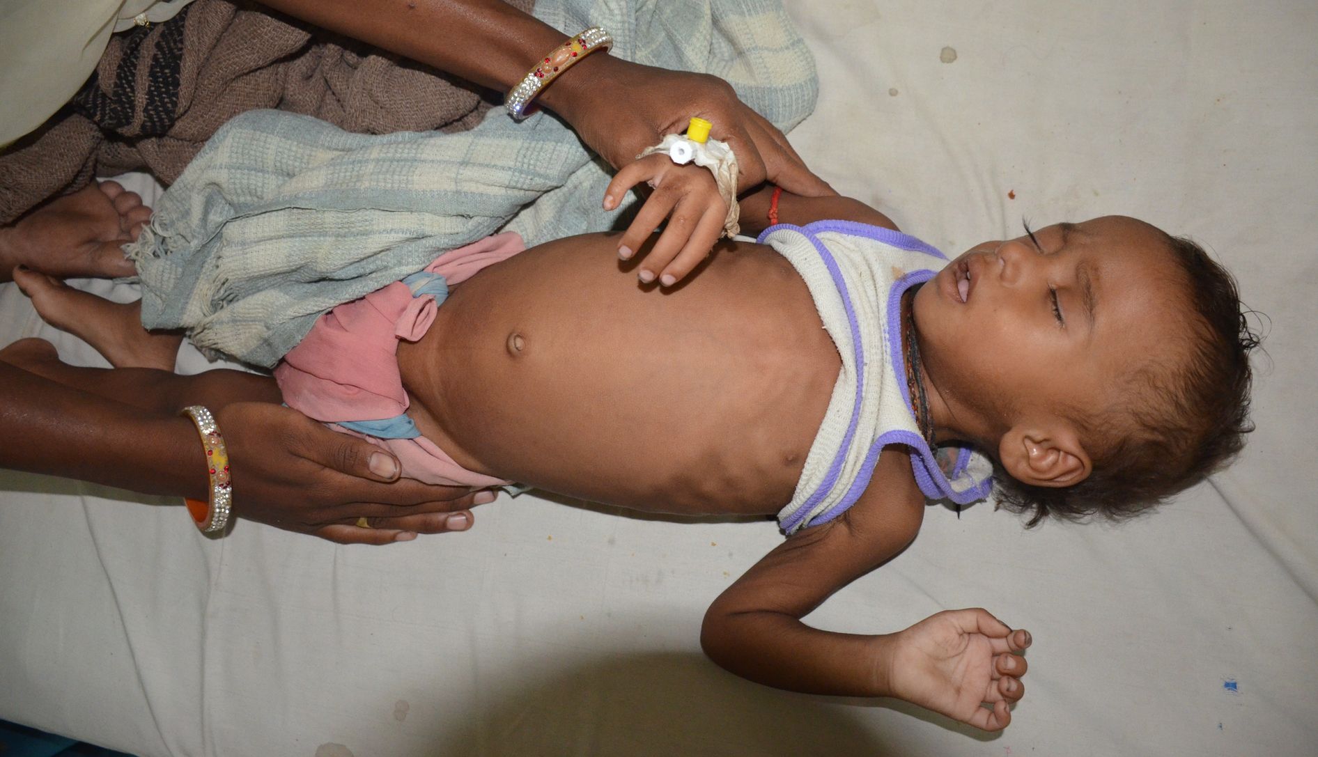 malnutrition in rajasthan कुपोषण ‘ गटक’ गया अरबों रुपए, दूर नहीं हुआ कुपोषित बच्चों के सामने आने का दंश