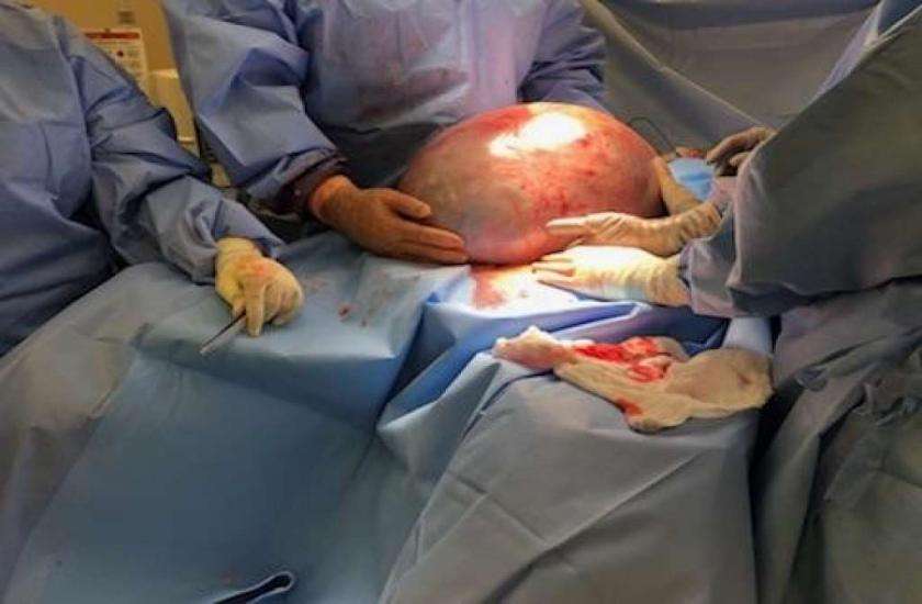 mucinous cystadenoma