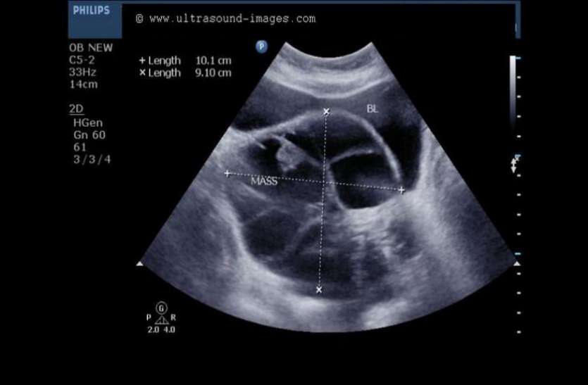 mucinous cystadenoma फूले हुए पेट को देखकर लोग समझ रहे थे प्रेग्नेंट, डॉक्टर्स ने निकाली ऐसी चीज जिसे देख हैरान हुई दुनिया
