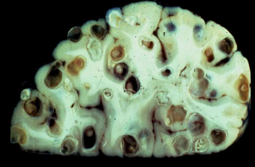 tapeworm eggs आठ साल की मासूम हंसते हुए झेल रही थी इस दर्द को, डॉक्टरों ने देखा तो दिमाग में रेंगते दिखे सैकड़ों कीड़े