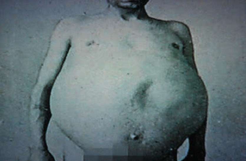 guy who did not poop for 13 long years see what happened to him 13 साल तक पॉटी करने नहीं गया ये शख्स और जब एक दिन हिम्मत जुटाई तो हुआ ये...