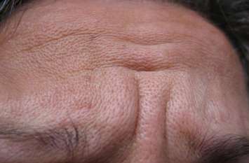 forehead lines forehead lines