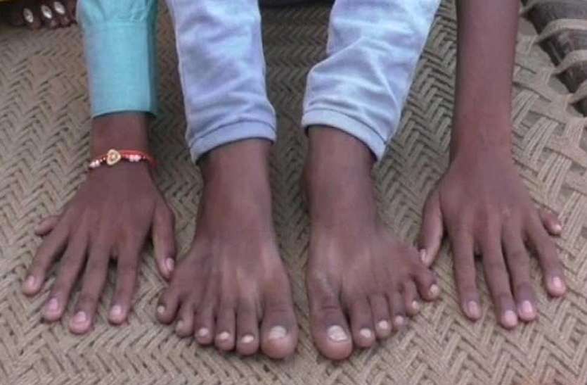 family claims boy with 12 fingers 12 toes faces threat to life 24 अंगुलियों वाले इस लड़के पर खतरा, तांत्रिक बोला- बलि दो बन जाओगे अमीर