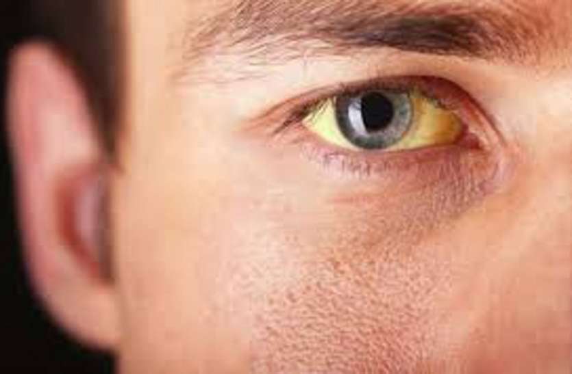 537 jaundice and 525 patients of typhoid in Ahmedabad पीलिया के ५३७ व टाइफाइड के ५२५ मरीज
