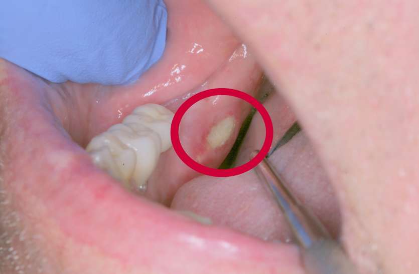 white patch फंगल इंफेक्शन से भी होते हैं मुंह में सफेद पैच