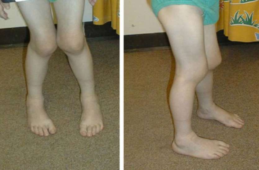 home remedies of arthritis in children world arthritis day: कम उम्र के बच्चे भी हो रहे आर्थराइटिस के शिकार, ऐसे करें बचाव
