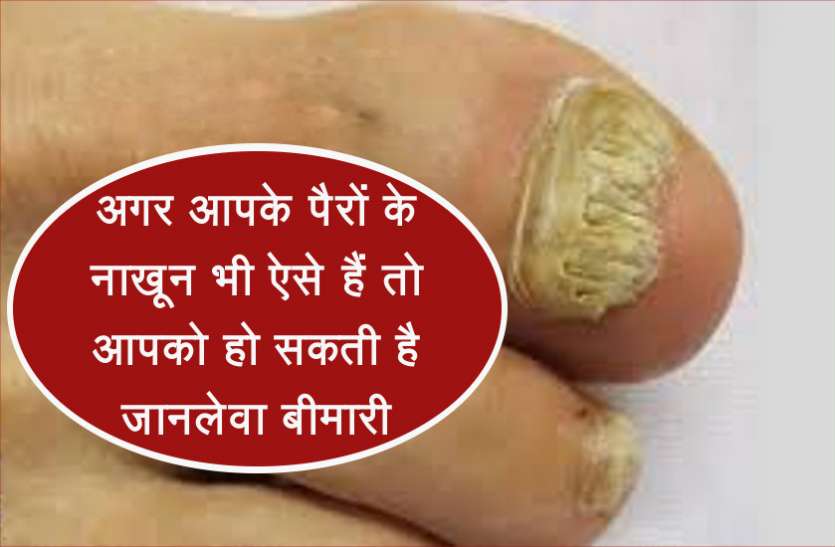 nails problem अगर आपके पैरों के नाखून भी एेसे हैं तो आपको हो सकती है जानलेवा बीमारी