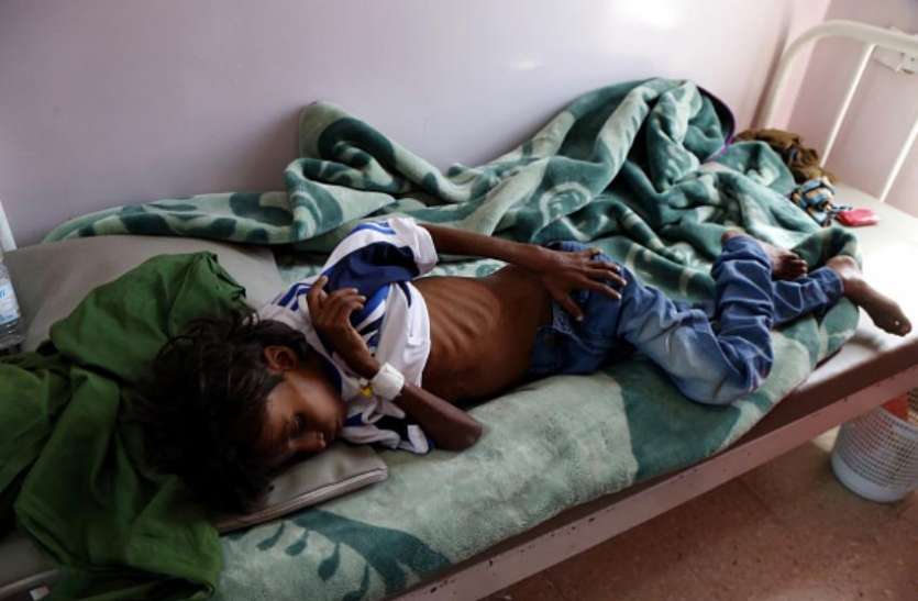 malnutrition यमनः धार्मिक संगठन का दावा, तीन साल में कुपोषण से 85 हजार बच्चों की