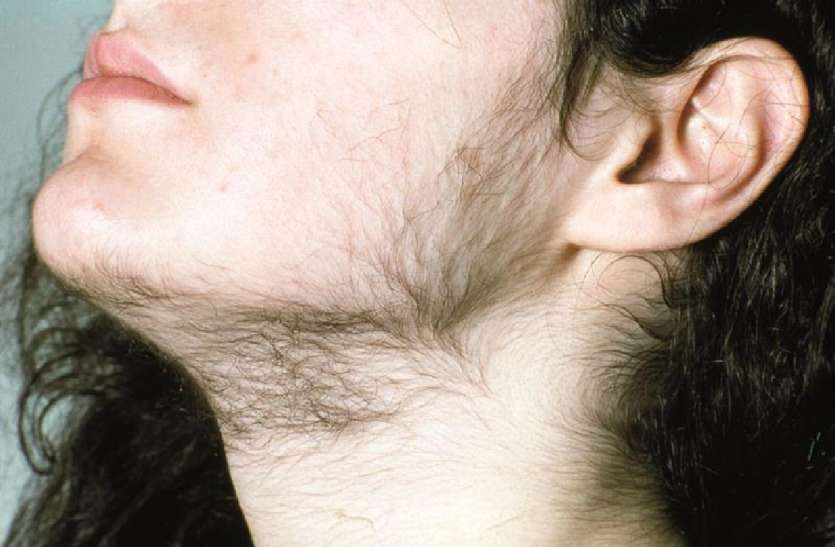 women-look-like-men-with-hormones-disorder हार्मोन की गड़बड़ी से महिलाएं दिखती हैं पुरुषों जैसी