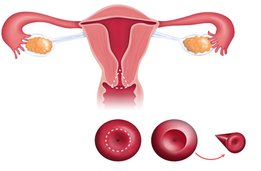 women's health women's health - सर्विक्स कैंसर के बारे में बताएगी डीएनए स्टडी