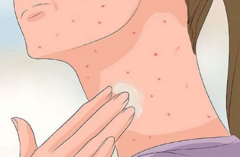 chicken pox यूपी में बढ़ा चिकन पॉक्स का प्रकोप, एक दर्जन से ज्यादा बीमारी की चपेट में