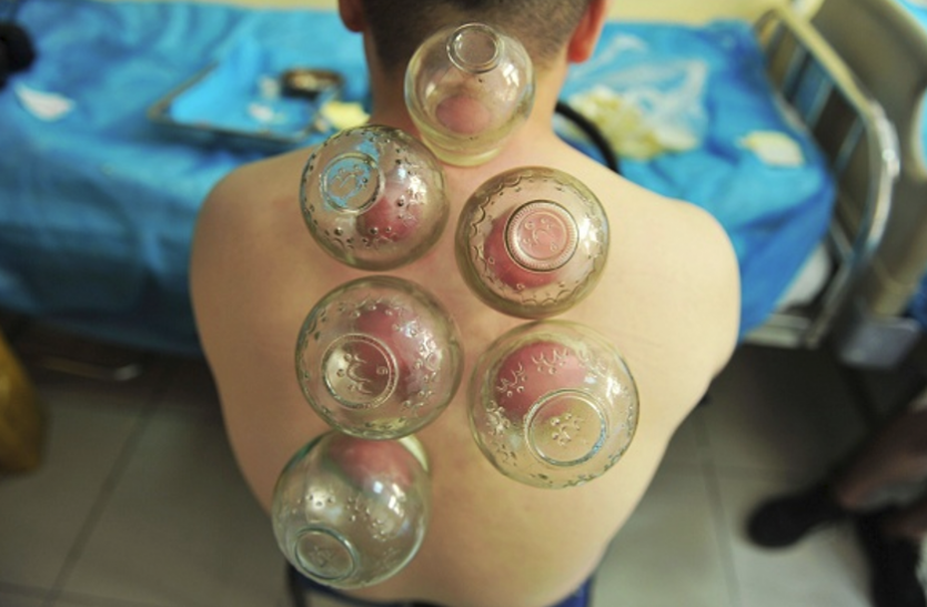 cupping Therapy जॉइंट पेन व माइग्रेन काे जड़ से दूर करती है यूनानी कपिंग थैरेपी