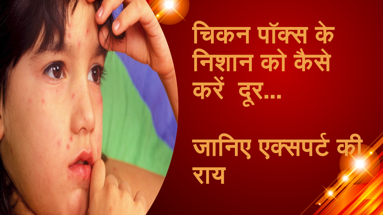 चिकन पॉक्स के निशान को कैसे करें दूर, जानिए एक्सपर्ट की राय |How to